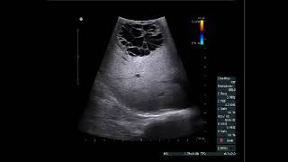 Abdominal Case Conference  3292022 [upl. by Denver]