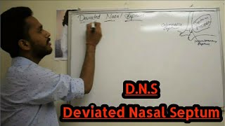 DEVIATED NASAL SEPTUM  DNS [upl. by Nus]