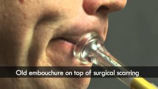 Trumpet embouchure before and after surgery [upl. by Lind]