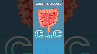 Revise Crohns Disease explained via Mnemonic [upl. by Gus489]