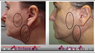 Fibrosis to Face After a Face Lift  Aspen Facelift Treatment for Lumpy Knots [upl. by Dilks]