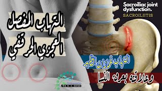 التهاب المفصل العجزي الحرقفي  والفرق بينه وبين عرق النسا  Sacroiliitis  SI joint dysfunction [upl. by Cleodell]