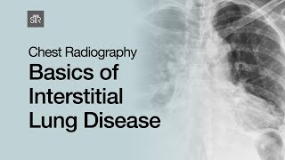 Chest Radiography Basics of Interstitial Lung Disease [upl. by Emie529]