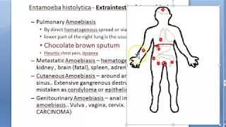 Parasitology 026 e Extraintestinal Amoebiasis entamoeba histolytica hepatic liver abscess anchovy [upl. by Ocram]