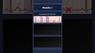 Type I Second Degree Atrioventricular Block ECG Increasing PR intervals [upl. by Marice]