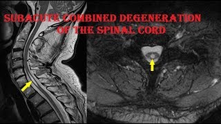 Subacute Combined Degeneration of the Spinal Cord important points drarmin anwar [upl. by Nahallac]