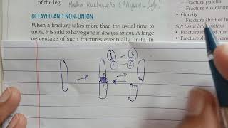 Delayed and NonUnion complications of fractures [upl. by Dewie]