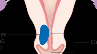 MNEMONIC  Risk Factors of Endometrial Cancer [upl. by Cuyler]