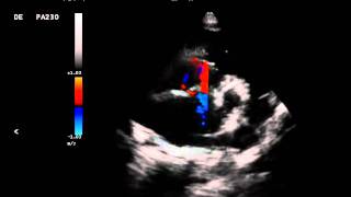 Comunicão Interatrial em Cão com Insuficiência Mitral [upl. by Nnaira345]