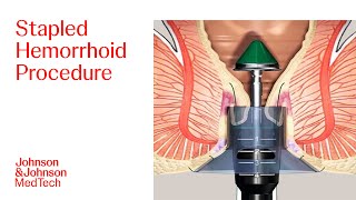 PPH Procedure Animation  Stapled Hemorrhoid Surgery  JampJ MedTech [upl. by Hazeghi827]