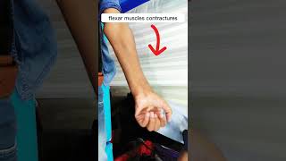 Volkmanns Ischimic contracture  volkman ischemia symptoms  volkmanns ischemia treatment [upl. by Yrellam722]