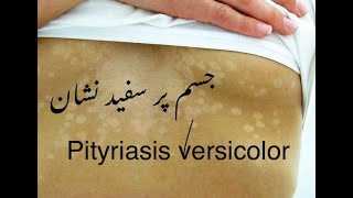 Pityriasis versicolor  جسم پر سفید نشان  funagal infection on skin DrHussainsharafat [upl. by Jola]