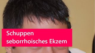 Schuppen  seborrhoisches Ekzem  seborrhoische Dermatitis [upl. by Hudis436]