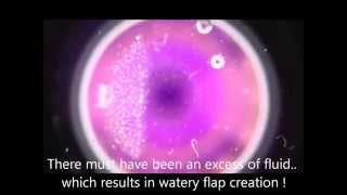 Femtosecond laser LASIK flap creation as seen by an iPhone [upl. by Akerboom]