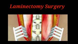 Laminectomy Surgery Animation  Lumbar spine surgery  Joshna Medical Education viral short [upl. by Nemzzaj327]