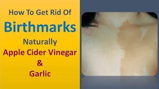 how to get rid of birthmarks naturally  Apple Cider Vinegar amp Garlic [upl. by Ecerahs]