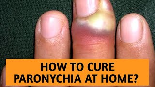 How to treat and prevent Paronychia under nails [upl. by Yekciv]