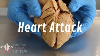 What Happens During a Heart Attack  Anatomy of a Heart Attack [upl. by Wash]