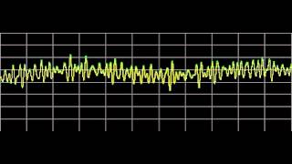 Hemangioma  Rife Frequencies [upl. by Justina531]