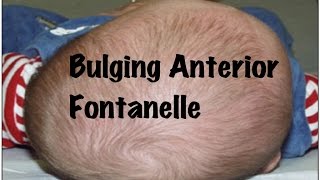 Quick Pediatrics Causes for Bulging of Anterior Fontanelle [upl. by Iddet]