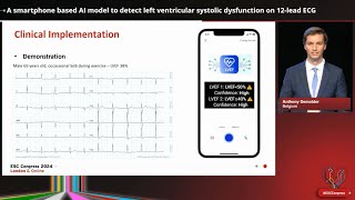 A smartphonebased AI model to detect left ventricular systolic dysfunction on ECG  ESC London 2024 [upl. by Dobbins549]