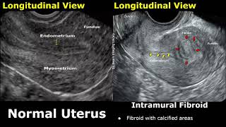 Uterus Ultrasound Normal Vs Intramural Fibroid Images  Uterine Leiomyomas USG Cases [upl. by Onnem21]