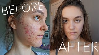 HOW TO GET RID OF ACNE  POST Doxycycline  MY SKINCARE ROUTINE [upl. by Mikael]