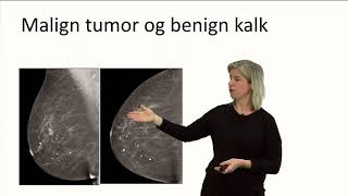 Klinisk mammografi  trippeldiagnostikk [upl. by Omora]