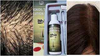 Imxia 5 Minoxidil Topical Solution USP 5 Review [upl. by Anaerdna]