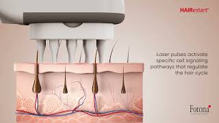 HAIRestart®  NonInvasive Laser Stimulation of Hair Growth [upl. by Ispep715]