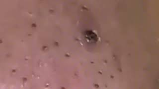 Satisfying Pimple Popping blackhead with relaxing [upl. by Donelson]