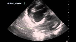 Right atrial systolic collapse indicating early tamponade physiology [upl. by Zolnay564]