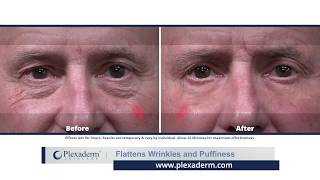 Plexaderm Flattens Wrinkles and Puffiness [upl. by Nylakcaj]