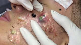 Big Cystic Acne Blackheads Extraction Blackheads amp Milia Whiteheads Removal Pimple Popping 11 [upl. by Gad]