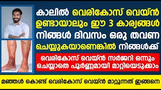 വെരികോസ് വെയ്ൻ സർജറി ചെയ്യാതെ പൂർണമായി മാറ്റാൻ മഞ്ഞൾ ഇങ്ങനെ ഉപയോഗിച്ചാൽ മതി vericose vein malayalam [upl. by Einor572]