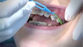 How to Wear Orthodontic Elastic Bands [upl. by Enaelem]