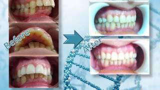 العلاج التقويمي للبروز الشديد في الأسنان العلوية Orthodontic treatment of severe protrusion [upl. by Lazor]