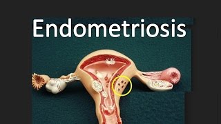 Endometriosis [upl. by Fredela]