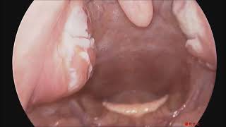 Acute Tonsillitis with Hypertrophic Tonsils [upl. by Yro]