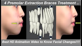 Changes in Face After 4 1st Premolars Extraction amp Braces Treatment Best HD Animation  Dr Ram MDS [upl. by Mahan919]