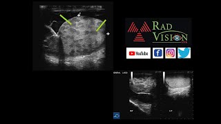 MILIARY PATTERN IN TB TESTIS GREAT MASQUERADER [upl. by Terri659]