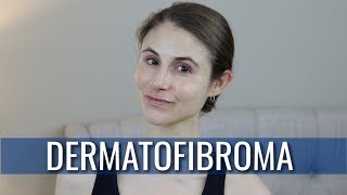 DERMATOFIBROMA WHAT IS IT HOW IS IT TREATED  DR DRAY [upl. by Slohcin376]