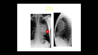 TD Le syndrome mediastinal Pr METAHRI [upl. by Hseyaj]