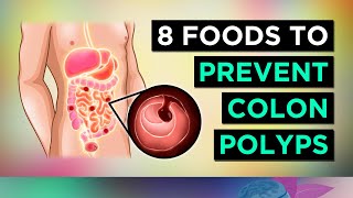 8 Foods To Prevent COLON POLYPS amp BOWEL CANCER [upl. by Crispin]