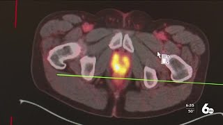 Wellness Wednesday PSMA Pet Scan screening for spreading Prostate Cancer cells [upl. by Benil]