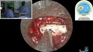 Rt L5S1 endo discectomy [upl. by Doraj]