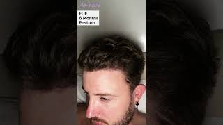 FUE Hair Transplant  6 Months Results [upl. by Yhtak]