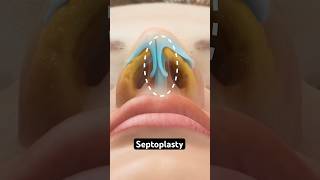 Septoplasty 3D Animation [upl. by Lydon]