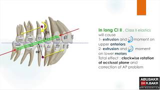 Long and short Class II elastics [upl. by Claiborne]