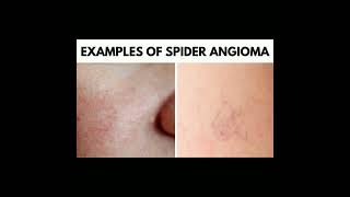 Spider Angioma [upl. by Nilhtac744]